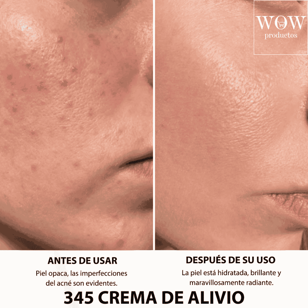 ReparaDerm™ | Crema para Marcas de Acné